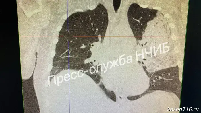 Doctors at the Naberezhnye Chelny Infectious Diseases Hospital saved a patient with severe lung damage.