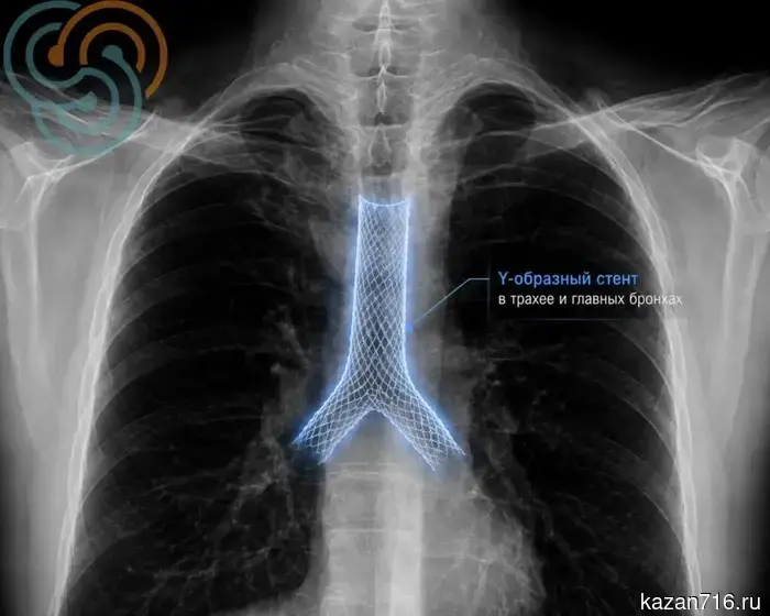 Endoscopists of the Republican Oncology Center have restored a patient's breathing for the first time in Tatarstan by using a Y-shaped stent.
