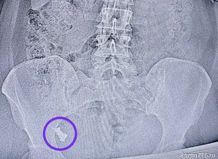 Doctors at the Republican Clinical Hospital of Tatarstan removed a denture from a woman's intestine that she had swallowed.